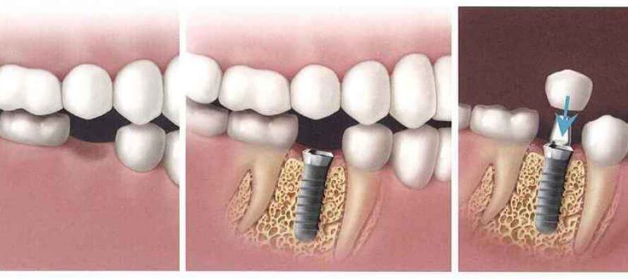 Tipuri de implanturi dentare