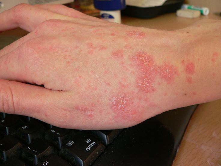 Scabia – boală contagioasă determinată de ectoparaziți
